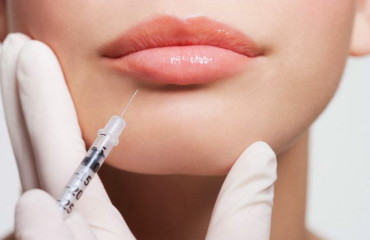 FILLER DI ACIDO IALURONICO